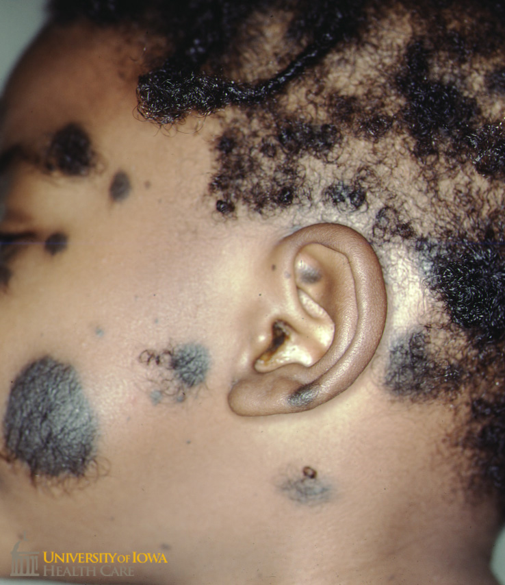 Multiple ovoid black plaques with hypertrichosis on the cheeks, ear, and neck. (click images for higher resolution).